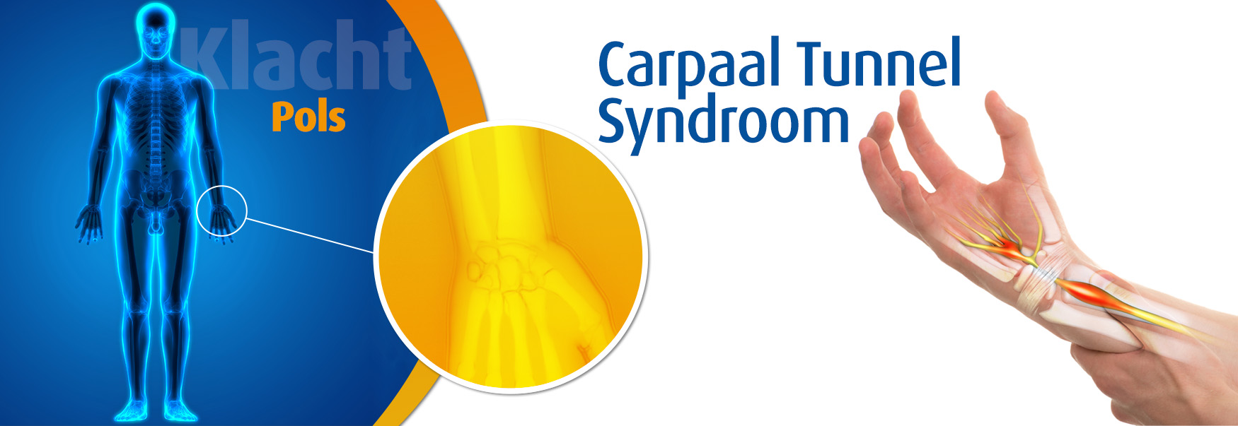 Carpaal tunnel syndroom Wat is het? Podobrace